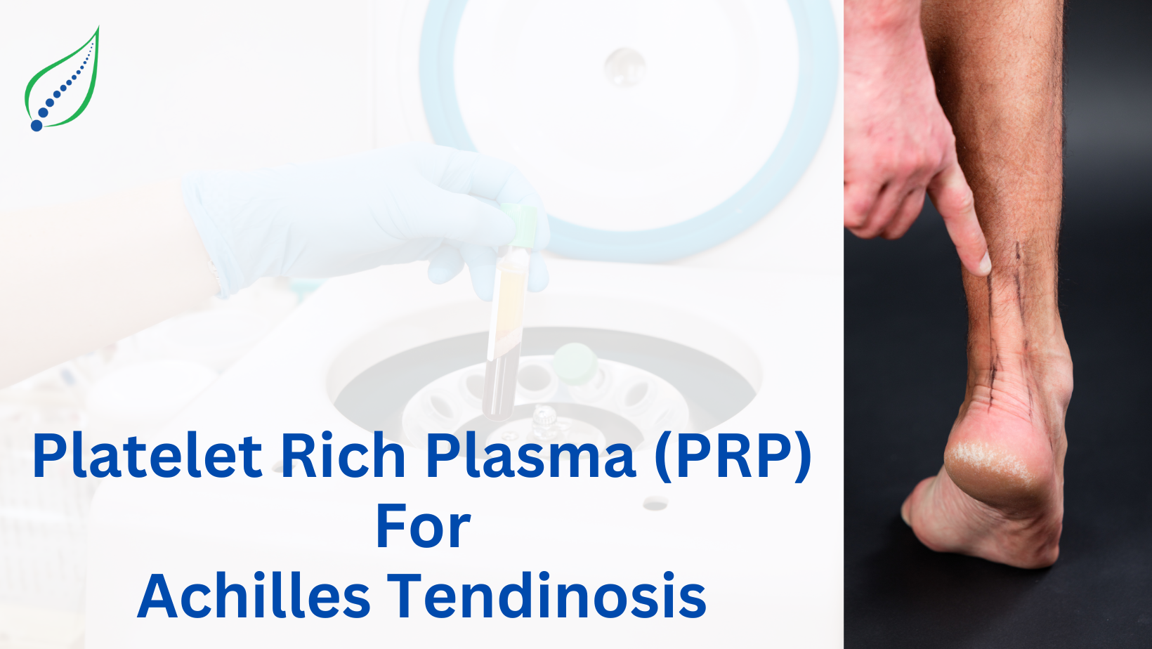PRP For Achilles Tendinosis
